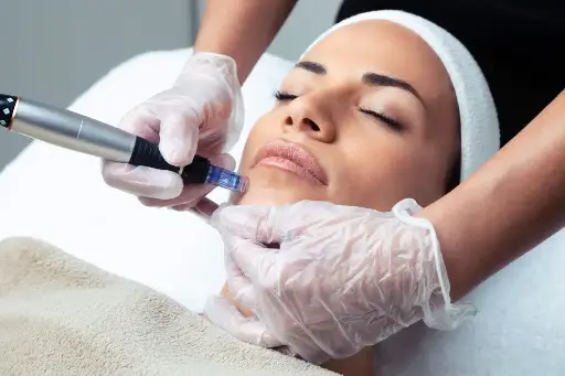 Microneedling RF Acne out